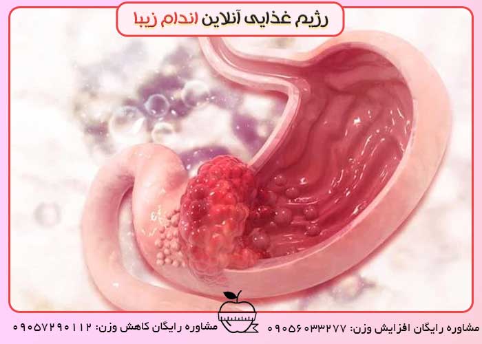 چه عواملی باعث زخم معده می‌شود؟