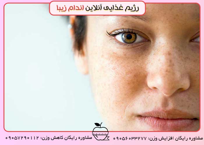 لک های دوران بارداری