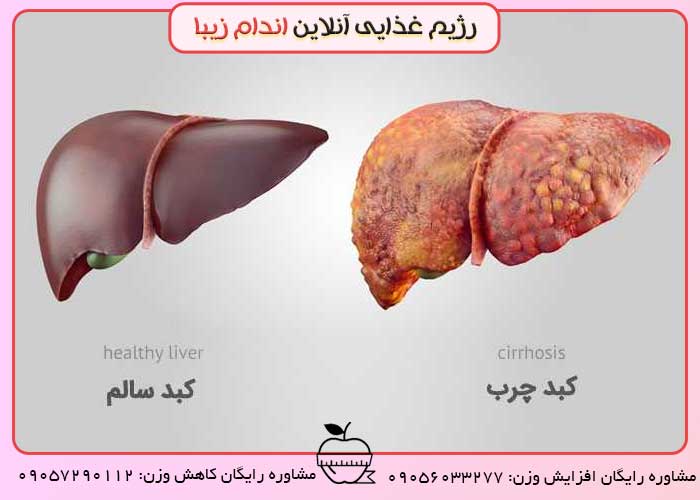 مهمترین عامل کبد چرب را بشناسید